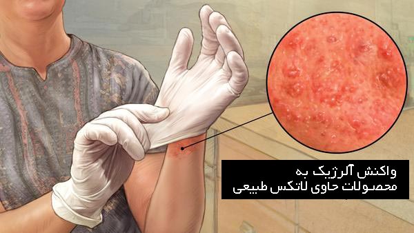 حساسیت به لاتکس