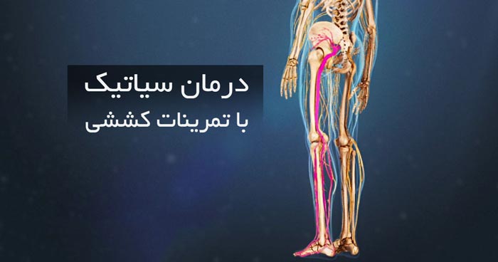 درمان سیاتیک